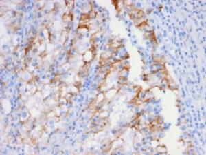 Immunohistochemical analysis of formalin-fixed, paraffin-embedded human renal cell carcinoma using Anti-Cadherin 16 Antibody [CDH16/2448]