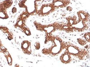 Immunohistochemical analysis of formalin-fixed, paraffin-embedded human breast carcinoma using Anti-Calpastatin Antibody [CAST/1550]