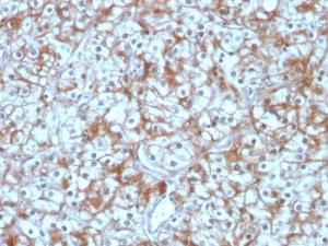 Immunohistochemical analysis of formalin-fixed, paraffin-embedded human bladder carcinoma using Anti-Calpastatin Antibody [CAST/1550]