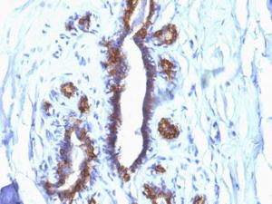 Immunohistochemical analysis of formalin-fixed, paraffin-embedded human breast carcinoma using Anti-MUC1 Antibody [SPM132]