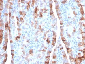 Immunohistochemical analysis of formalin-fixed, paraffin-embedded human thyroid carcinoma using Anti-Thyroid Peroxidase Antibody [TPO/3701]