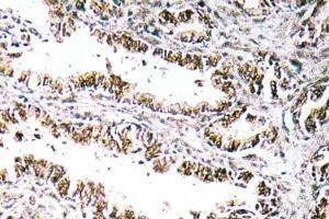 Immunohistochemical analysis of paraffin-embedded human prostate carcinoma tissue using Anti-STEAP1 Antibody