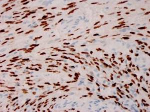 Immunohistochemical analysis of formalin-fixed, paraffin-embedded human Kaposi's sarcoma using Anti-HHV8 LNA-1 Antibody [HHV8/3606]