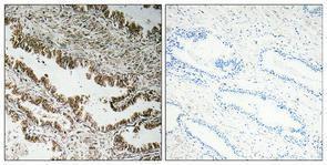 Immunohistochemical analysis of paraffin-embedded human prostate cancer using Anti-STEAP1 Antibody 1:100 (4°C overnight) The right hand panel represents a negative control, where the antibody was pre-incubated with the immunising peptide