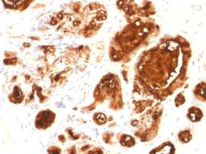 Immunohistochemical analysis of formalin-fixed, paraffin-embedded human breast carcinoma using Anti-MUC1 Antibody [rMUC1/960]