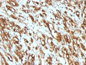 Immunohistochemical analysis of formalin-fixed, paraffin-embedded human rhabdomyosarcoma using Anti-Muscle Actin Antibody [MSA/953]