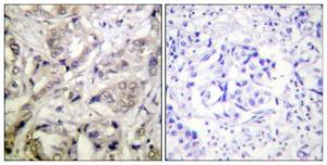 Immunohistochemical analysis of paraffin-embedded human breast carcinoma tissue using Anti-CaMK1-alpha Antibody The right hand panel represents a negative control, where the antibody was pre-incubated with the immunising peptide