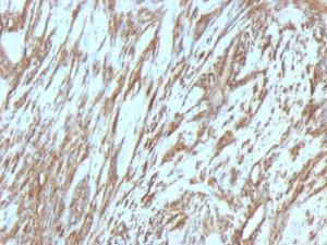 Immunohistochemical analysis of formalin-fixed, paraffin-embedded human leiomyosarcoma using Anti-Muscle Actin Antibody [MSA/953]