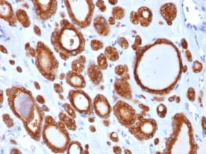 Immunohistochemical analysis of formalin-fixed, paraffin-embedded human thyroid carcinoma using Anti-Thyroid Peroxidase Antibody [TPO/1921]