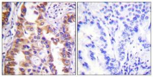 Immunohistochemical analysis of paraffin-embedded human lung carcinoma tissue using Anti-Tuberin Antibody. The right hand panel represents a negative control, where the antibody was pre-incubated with the immunising peptide