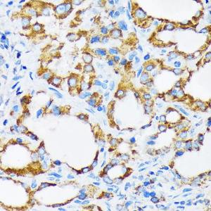 Immunohistochemistry analysis of paraffin-embedded human thyroid cancer using Anti-PIST Antibody [ARC1831] (A307711) at a dilution of 1:100 (40X lens). Perform microwave antigen retrieval with 10 mM Tris/EDTA buffer pH 9.0 before commencing with IHC staining protocol