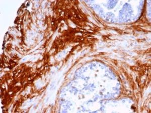 Immunohistochemical analysis of formalin-fixed, paraffin-embedded human prostate carcinoma tissue using Anti-Decorin Antibody [DCN/7031R]