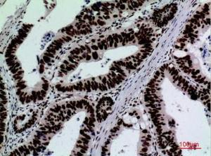 Immunohistochemical analysis of paraffin-embedded human colon cancer using Anti-SIGLEC7 Antibody