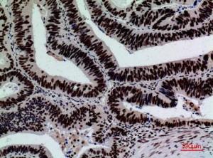 Immunohistochemical analysis of paraffin-embedded human colon cancer using Anti-SIGLEC7 Antibody