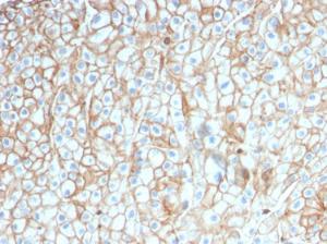 Immunohistochemical analysis of formalin-fixed, paraffin-embedded human lung squamous cell carcinoma using Anti-PD-L1 Antibody [PDL1/2746]