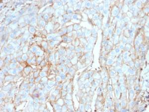 Immunohistochemical analysis of formalin-fixed, paraffin-embedded human cervical carcinoma using Anti-PD-L1 Antibody [PDL1/2746]