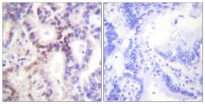 Immunohistochemical analysis of paraffin-embedded human lung carcinoma tissue using Anti-p15 INK Antibody. The right hand panel represents a negative control, where the antibody was pre-incubated with the immunising peptide