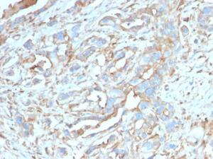 Immunohistochemical analysis of formalin-fixed, paraffin-embedded human breast carcinoma using Anti-PD-L1 Antibody [PDL1/2746]