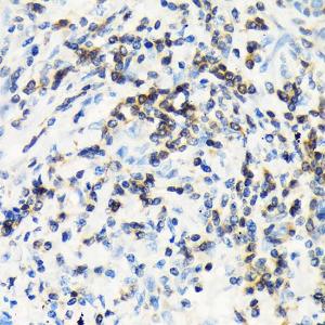 Immunohistochemistry analysis of paraffin-embedded human lung cancer using Anti-CSK Antibody [ARC1835] (A307712) at a dilution of 1:100 (40x lens). Perform microwave antigen retrieval with 10 mM Tris/EDTA buffer pH 9.0 before commencing with IHC staining protocol.