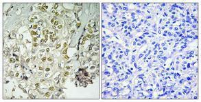 Immunohistochemical analysis of paraffin-embedded human lung cancer using Anti-RAD51L3 Antibody 1:100 (4 °C overnight). The right hand panel represents a negative control, where the Antibody was pre-incubated with the immunising peptide