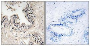 Immunohistochemical analysis of paraffin-embedded human prostate carcinoma tissue using Anti-MRPS36 Antibody. The right hand panel represents a negative control, where the antibody was pre-incubated with the immunising peptide.