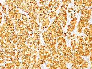 Immunohistochemical analysis of formalin-fixed, paraffin-embedded human melanoma using Anti-MelanA Antibody [M2-7C10]