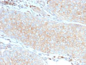 Immunohistochemical analysis of formalin-fixed, paraffin-embedded human basal cell carcinoma using Anti-PD-L1 Antibody [PDL1/2746]