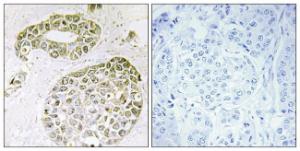 Immunohistochemical analysis of paraffin-embedded human breast carcinoma tissue using Anti-hnRNP M Antibody. The right hand panel represents a negative control, where the antibody was pre-incubated with the immunising peptide.