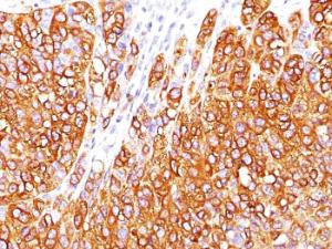 Immunohistochemical analysis of formalin-fixed, paraffin-embedded human melanoma using Anti-MelanA Antibody [M2-7C10]