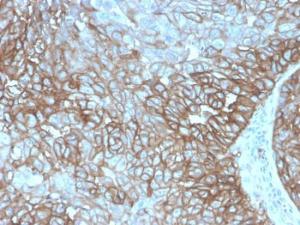 Immunohistochemical analysis of formalin-fixed, paraffin-embedded human lung squamous cell carcinoma using Anti-PD-L1 Antibody [PDL1/4280R]