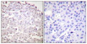 Immunohistochemical analysis of paraffin-embedded human breast carcinoma tissue using Anti-GADD153 Antibody. The right hand panel represents a negative control, where the Antibody was pre-incubated with the immunising peptide