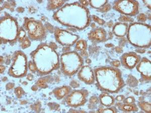 Immunohistochemical analysis of formalin-fixed, paraffin-embedded human thyroid carcinoma using Anti-Thyroid Peroxidase Antibody [TPO/3695]