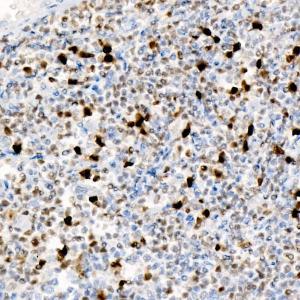 Immunohistochemistry analysis of paraffin-embedded human Follicular lymphoma using Anti-MUM1 Antibody [ARC58086] (A309925) at a dilution of 1:100/300/900 (40X lens). Perform high pressure antigen retrieval with 10 mM Tris/EDTA buffer pH 9.0 before commencing with IHC staining protocol