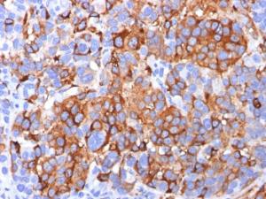 Immunohistochemical analysis of formalin-fixed, paraffin-embedded human melanoma using Anti-MelanA Antibody [A103]