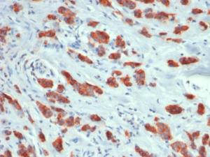 Immunohistochemical analysis of formalin-fixed, paraffin-embedded human breast carcinoma using Anti-MUC1 Antibody [MUC1/1887R]