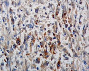 Immunohistochemistry analysis of human breast cancer The Primary Antibody used was Anti-Phosphotyrosine Antibody (A304808) at 1:100