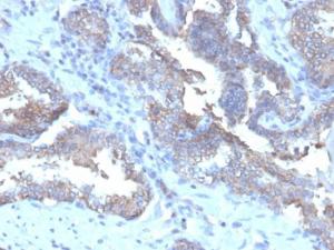 Immunohistochemical analysis of formalin-fixed, paraffin-embedded human prostate carcinoma using Anti-CD47 Antibody [CD47/6362R]