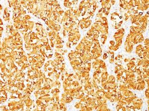 Immunohistochemical analysis of formalin-fixed, paraffin-embedded human melanoma using Anti-MelanA Antibody [DT101 + BC199]