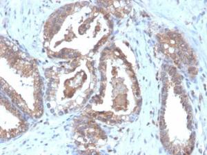 Immunohistochemical analysis of formalin-fixed, paraffin-embedded human prostate carcinoma using Anti-CD47 Antibody [CD47/6364R]