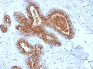 Immunohistochemical analysis of formalin-fixed, paraffin-embedded human breast carcinoma using Anti-MUC1 Antibody [rMUC1/4418]