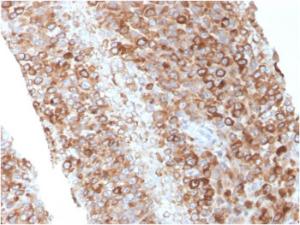 Immunohistochemical analysis of formalin-fixed, paraffin-embedded human melanoma using Anti-CD63 Antibody [LAMP3/2881]