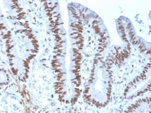 Immunohistochemical analysis of formalin-fixed, paraffin-embedded human colon carcinoma using Anti-MSH6 Antibody [rMSH6/4743]