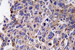 Immunohistochemical analysis of paraffin-embedded human lung carcinoma tissue using Anti-MMP-12 Antibody