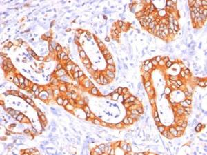 Immunohistochemical analysis of formalin-fixed, paraffin-embedded human colon carcinoma using Anti-MUC1 Antibody [GP14 + E29]