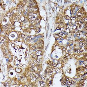 Immunohistochemistry analysis of paraffin-embedded human colon carcinoma tissue using Anti-MAK Antibody (A308925) at a dilution of 1:100 (40x lens). Perform microwave antigen retrieval with 10 mM PBS buffer pH 7.2 before commencing with IHC staining protocol.