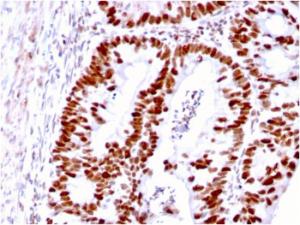 Immunohistochemical analysis of formalin-fixed, paraffin-embedded human colon carcinoma using Anti-MSH6 Antibody [MSH6/3085]