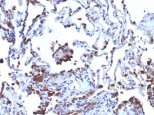 Immunohistochemical analysis of formalin-fixed, paraffin-embedded human melanoma metastasized to lung using Anti-CD63 Antibody [NKI/C3 + LAMP3/968]