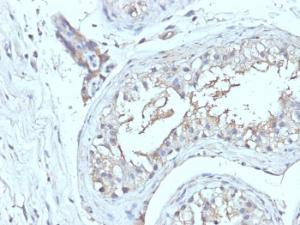 Immunohistochemical analysis of formalin-fixed, paraffin-embedded human testicular cancer using Anti-CD63 Antibody [NKI/C3 + LAMP3/968]