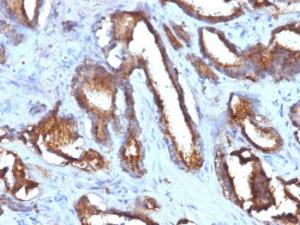 Immunohistochemical analysis of formalin-fixed, paraffin-embedded human prostate carcinoma using Anti-CD63 Antibody [NKI/C3 + LAMP3/968]