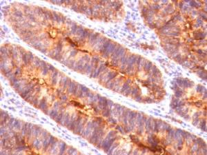 Immunohistochemical analysis of formalin-fixed, paraffin-embedded human colon carcinoma using Anti-MUC1 Antibody [MUC1/845]